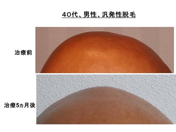 円形脱毛症　病院""
